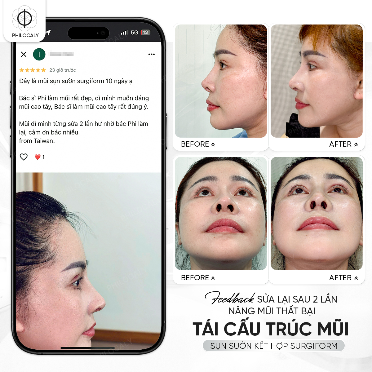 Feedback KH sau 10 ngày sửa mũi tại Thạc sĩ Bác sĩ Võ Thanh Phi.